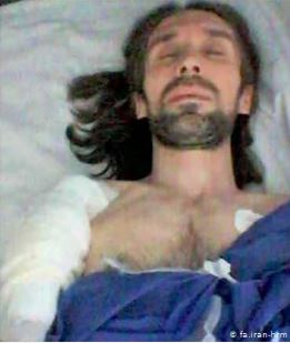 آرش صادقی پس از عمل جراحی بازو به علت سرطان در زندان