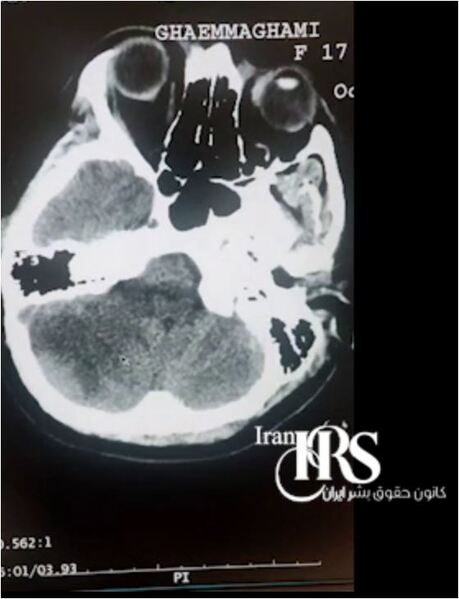 پرونده:اسکن مغز آرنیکا.JPG